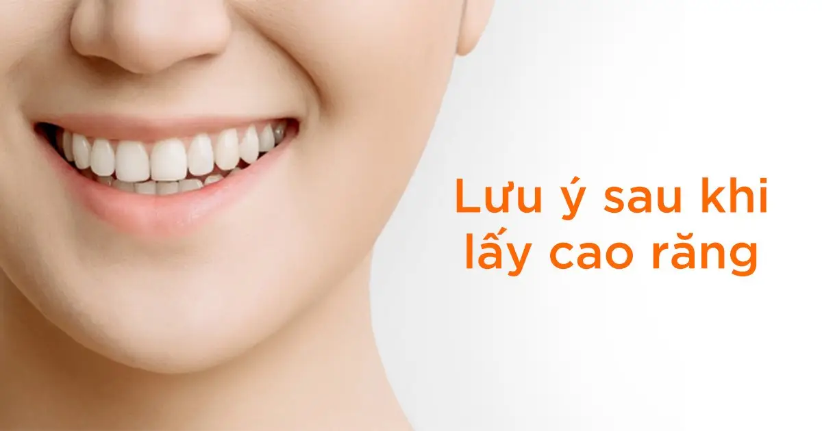 Lưu ý sau khi lấy cao răng