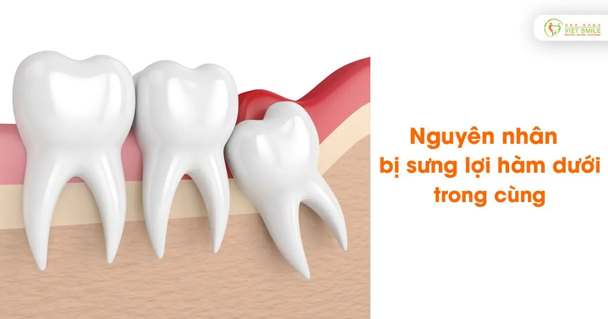 Nguyên nhân bị sưng lợi hàm dưới trong cùng
