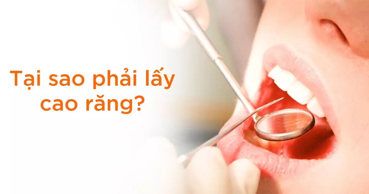Tại sao phải lấy cao răng?