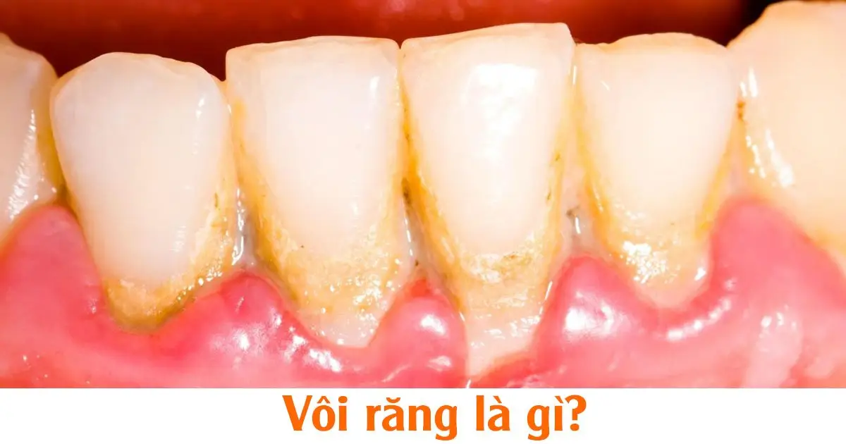 Vôi răng là gì?