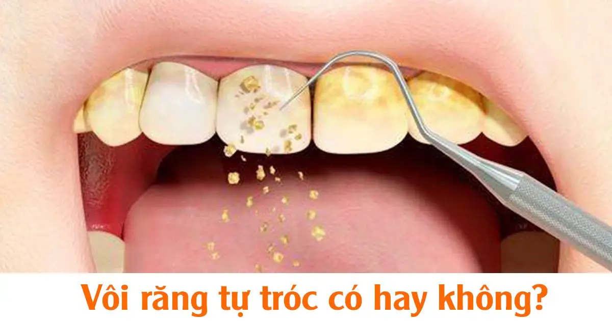 Vôi răng tự tróc có hay không?