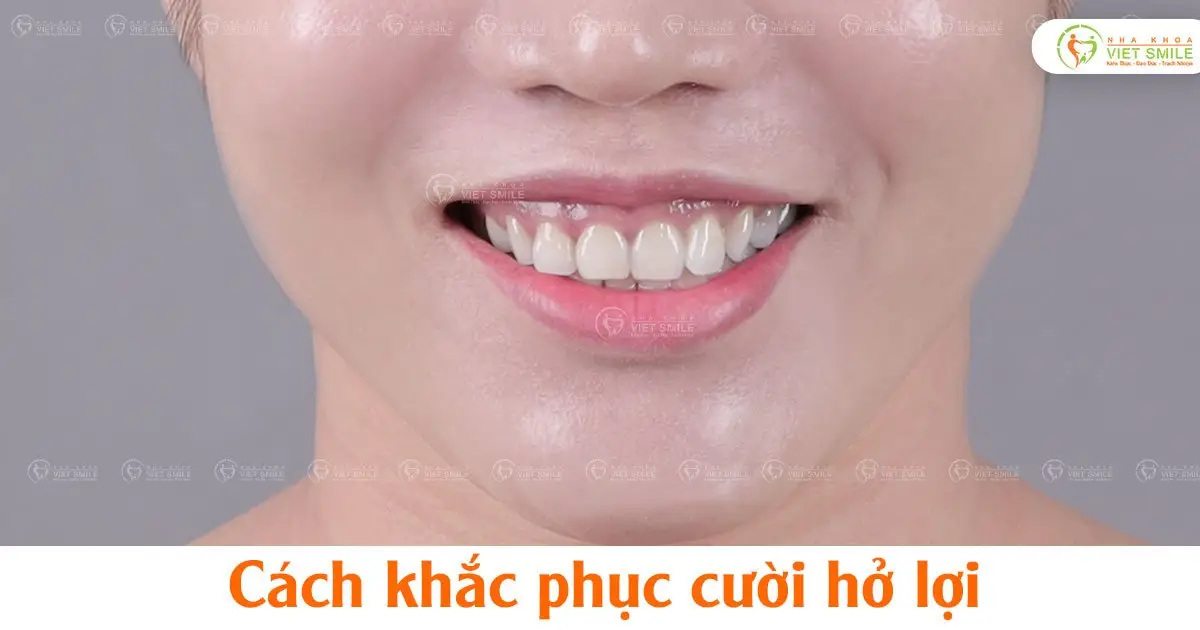 Cách khắc phục cười hở lợi