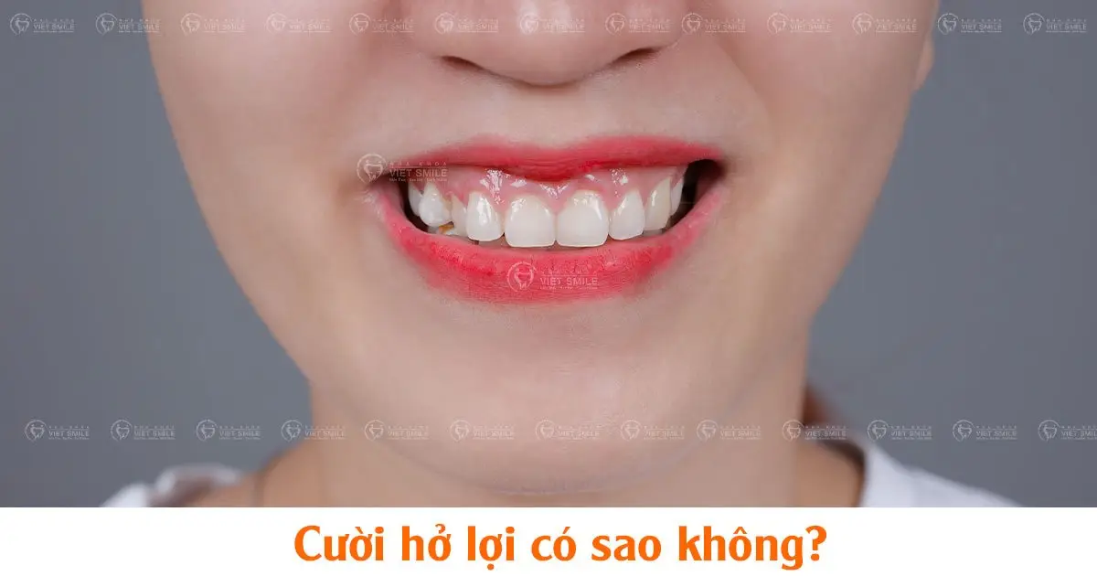 Cười hở lợi có sao không?