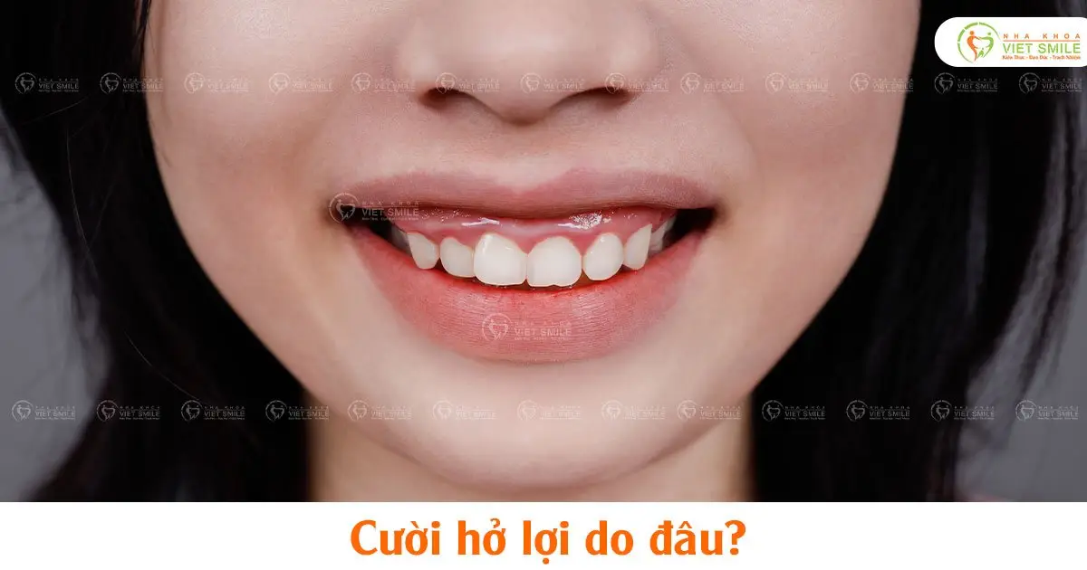 Cười hở lợi do đâu?