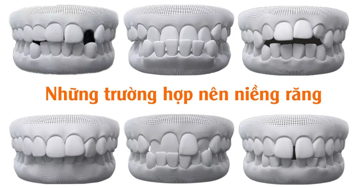 Những trường hợp nên niềng răng