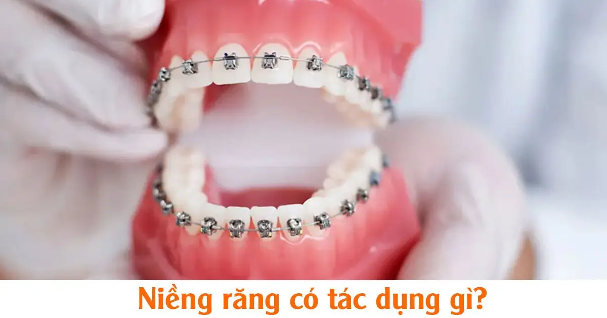 Niềng răng có tác dụng gì?