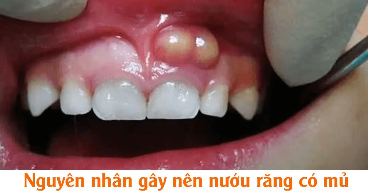 Nguyên nhân gây nên nướu răng có mủ