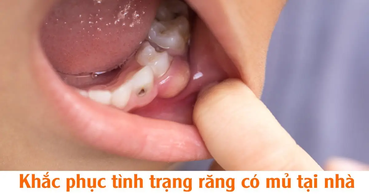 Khắc phục tình trạng răng có mủ tại nhà