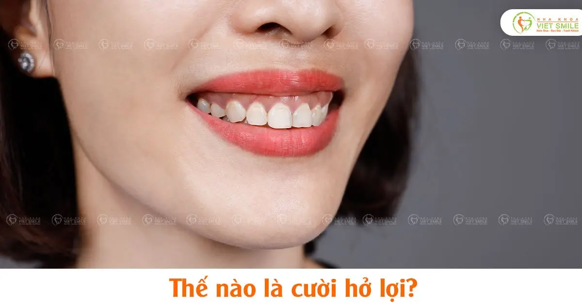 Thế nào là cười hở lợi?