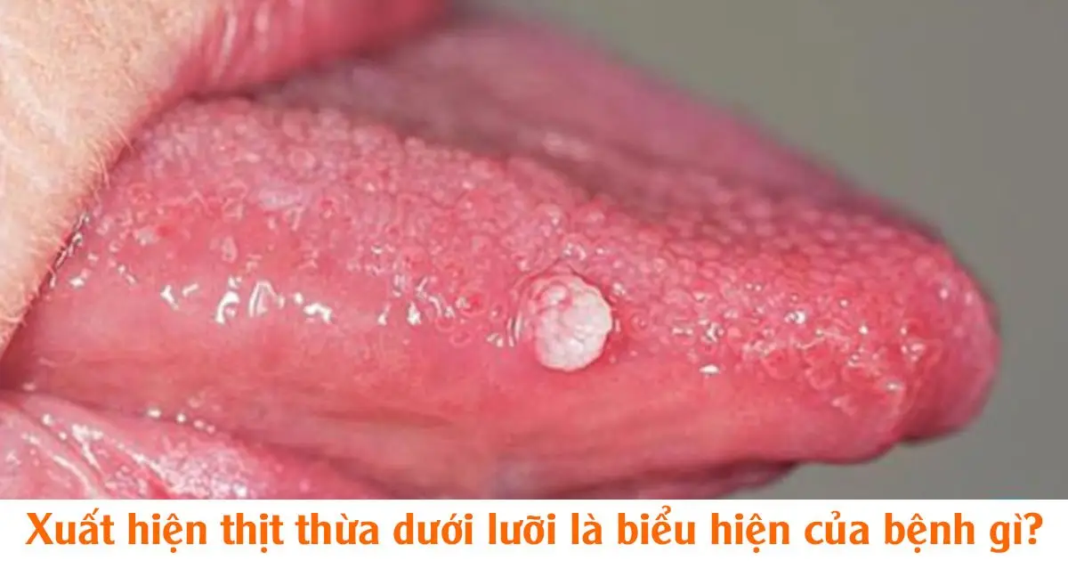 Xuất hiện thịt thừa dưới lưỡi là biểu hiện của bệnh gì?