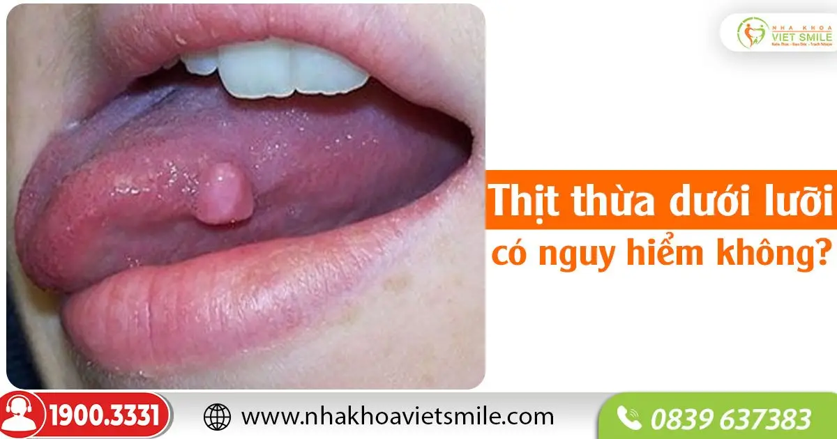 Thịt thừa dưới lưỡi có nguy hiểm không?