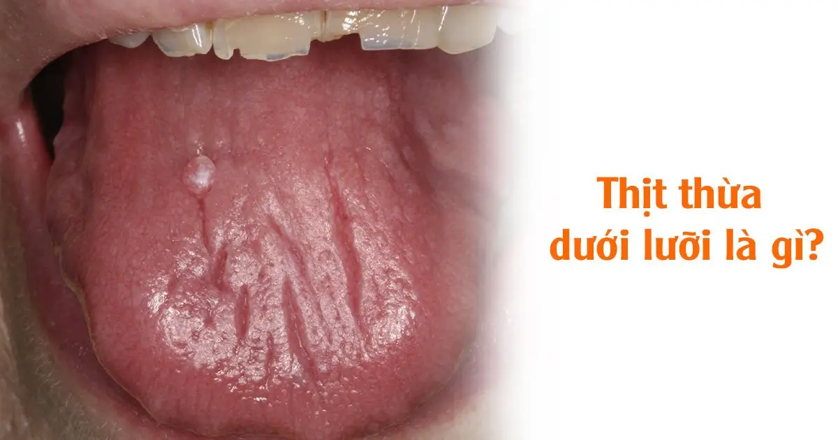 Thịt thừa dưới lưỡi là gì?