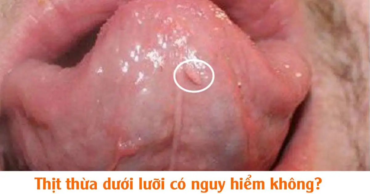 Thịt thừa dưới lưỡi có nguy hiểm không?