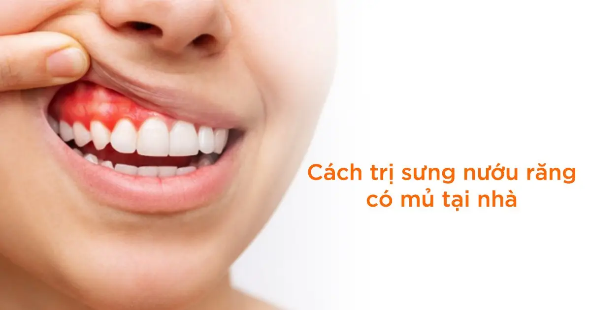 Cách trị sưng nướu răng có mủ tại nhà