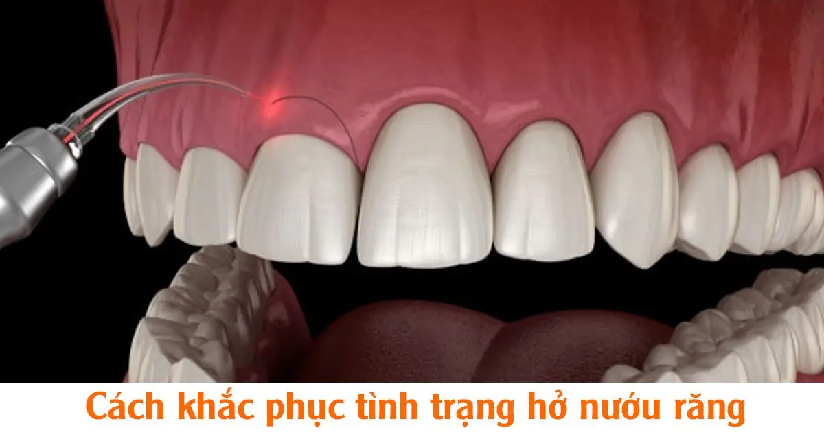 Cách khắc phục tình trạng hở nướu răng