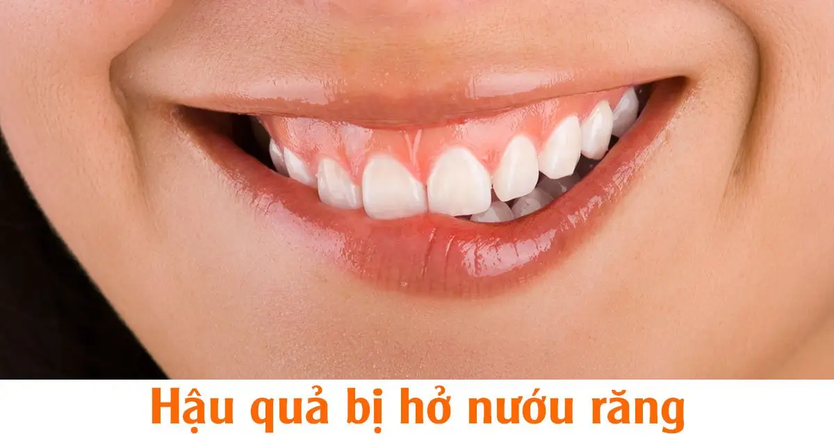Hậu quả bị hở nướu răng