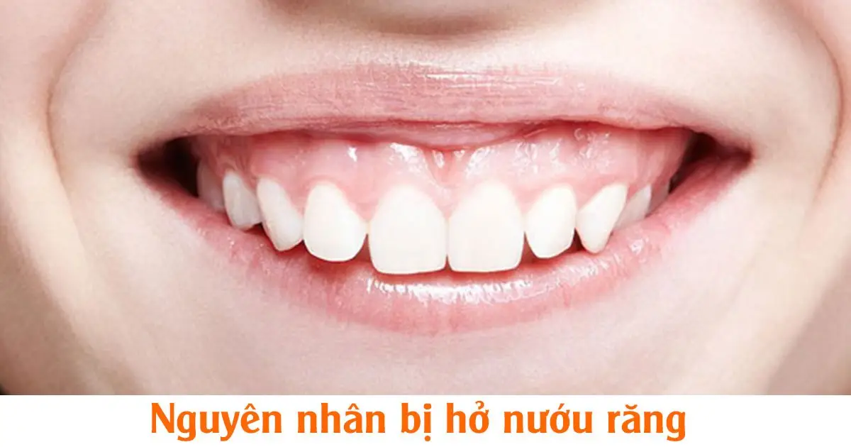 Nguyên nhân bị hở nướu răng