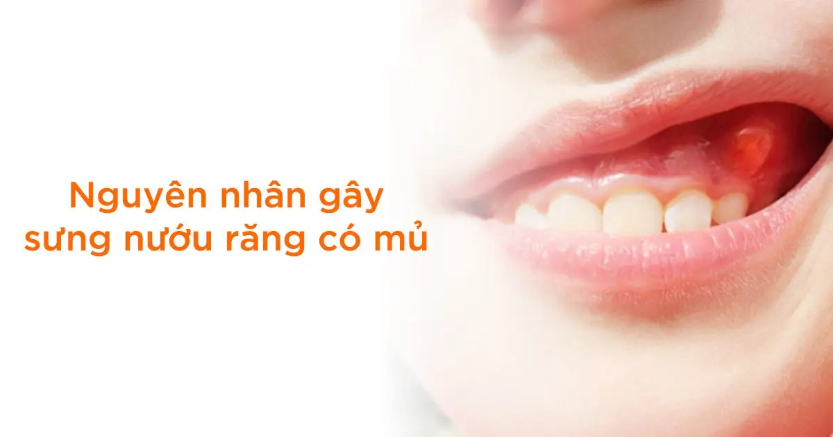Nguyên nhân gây sưng nướu răng có mủ