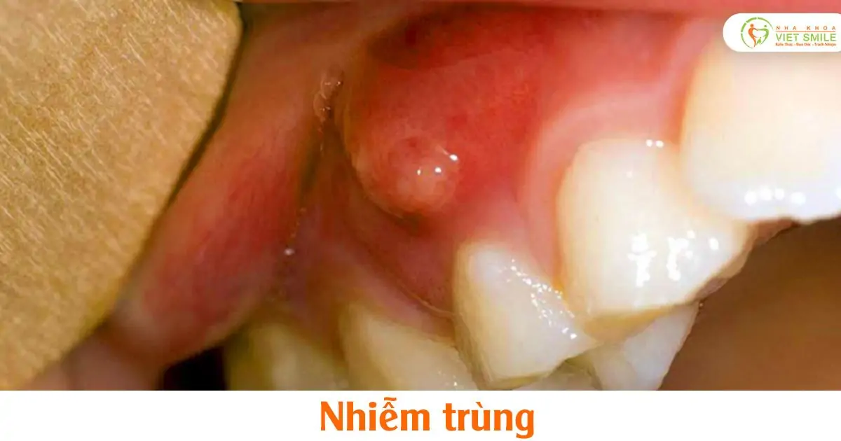 Nhiễm trùng