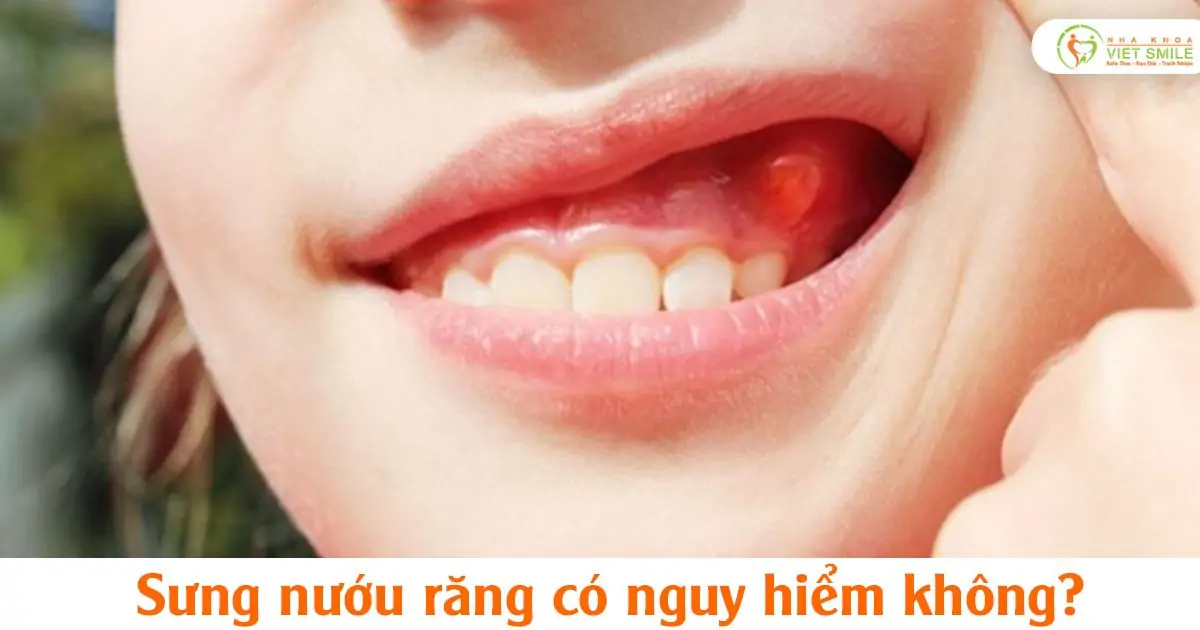 Sưng nướu răng có nguy hiểm không?