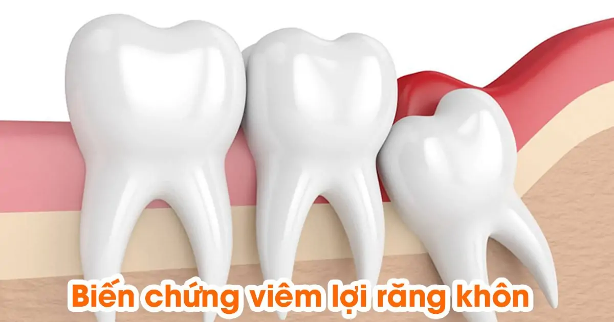 Biến chứng viêm lợi răng khôn
