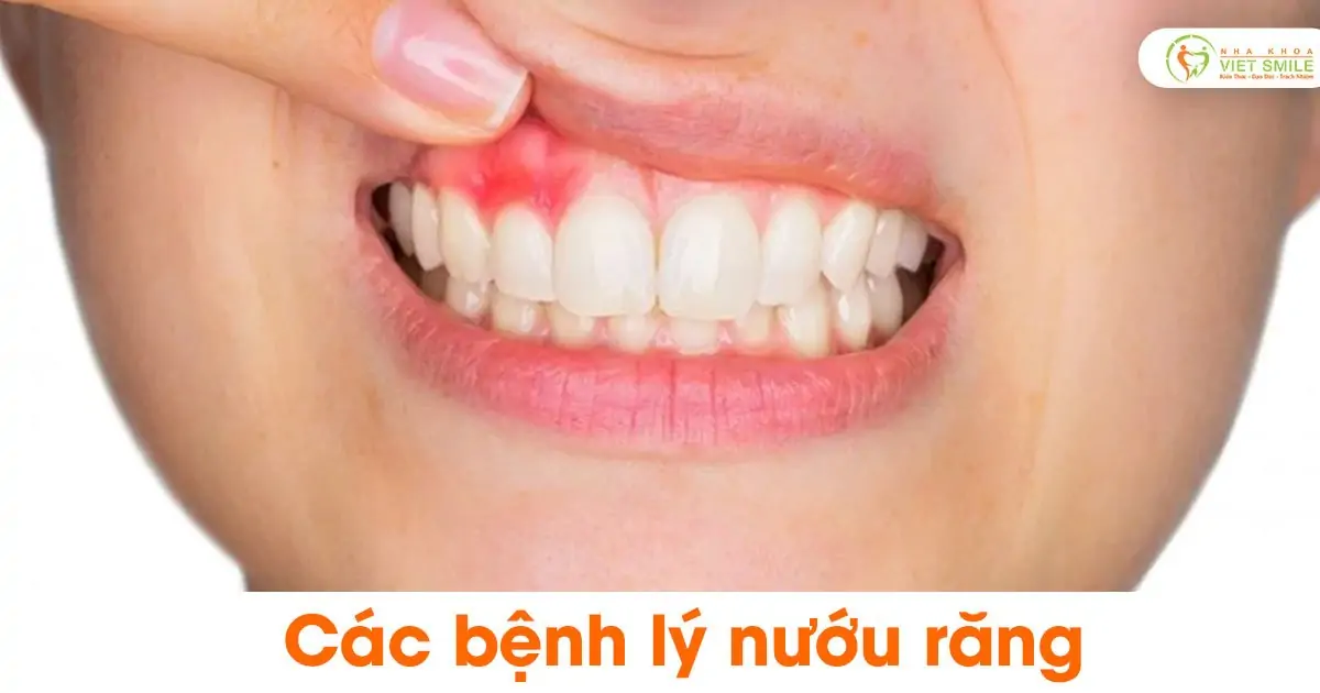 Các bệnh lý nướu răng