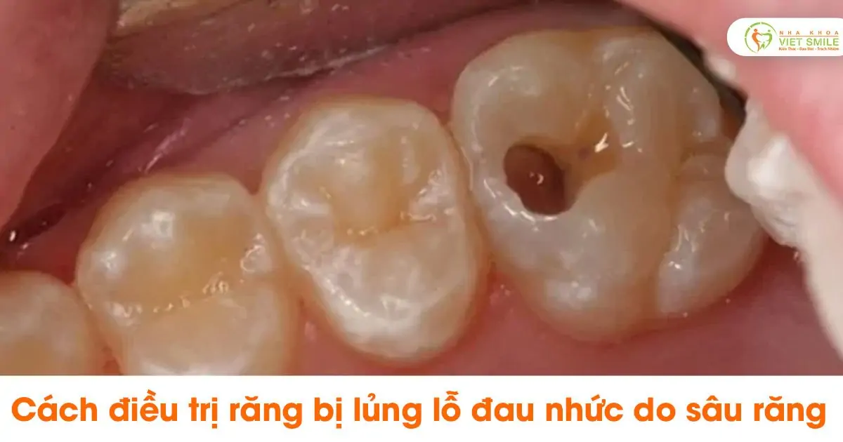Cách điều trị răng bị lủng lỗ đau nhức do sâu răng