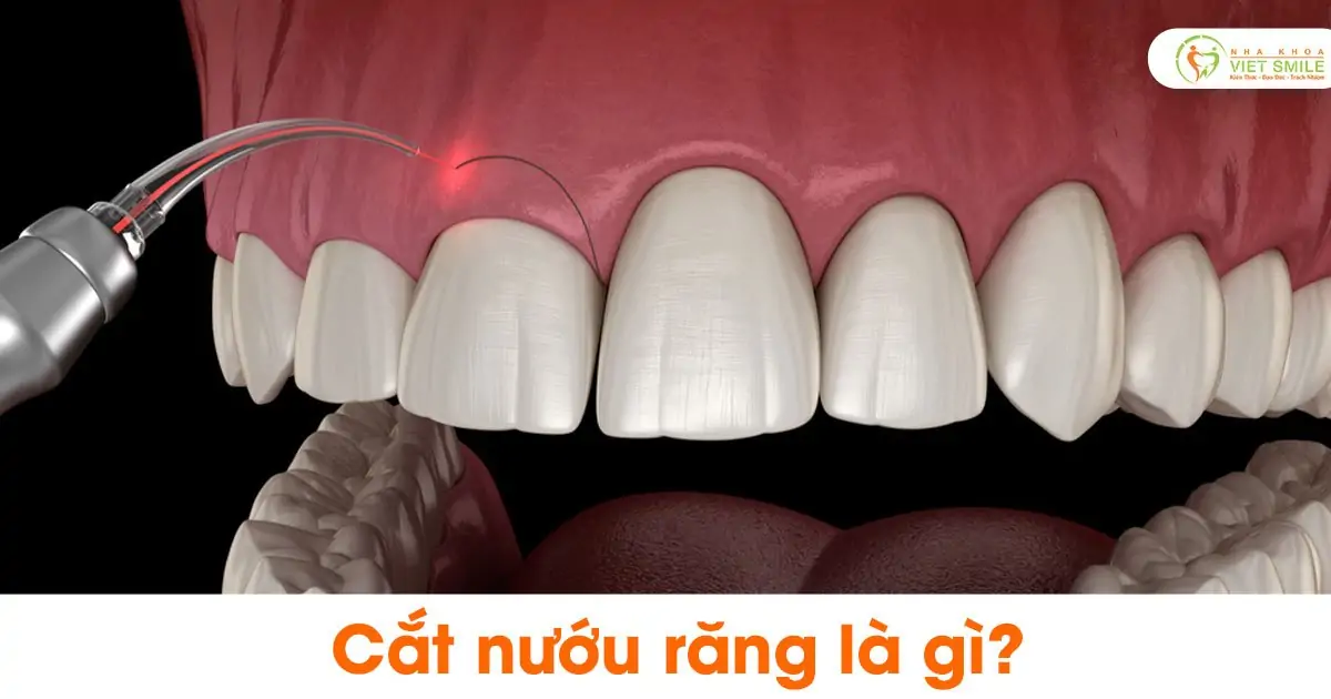 Cắt nướu răng là gì?