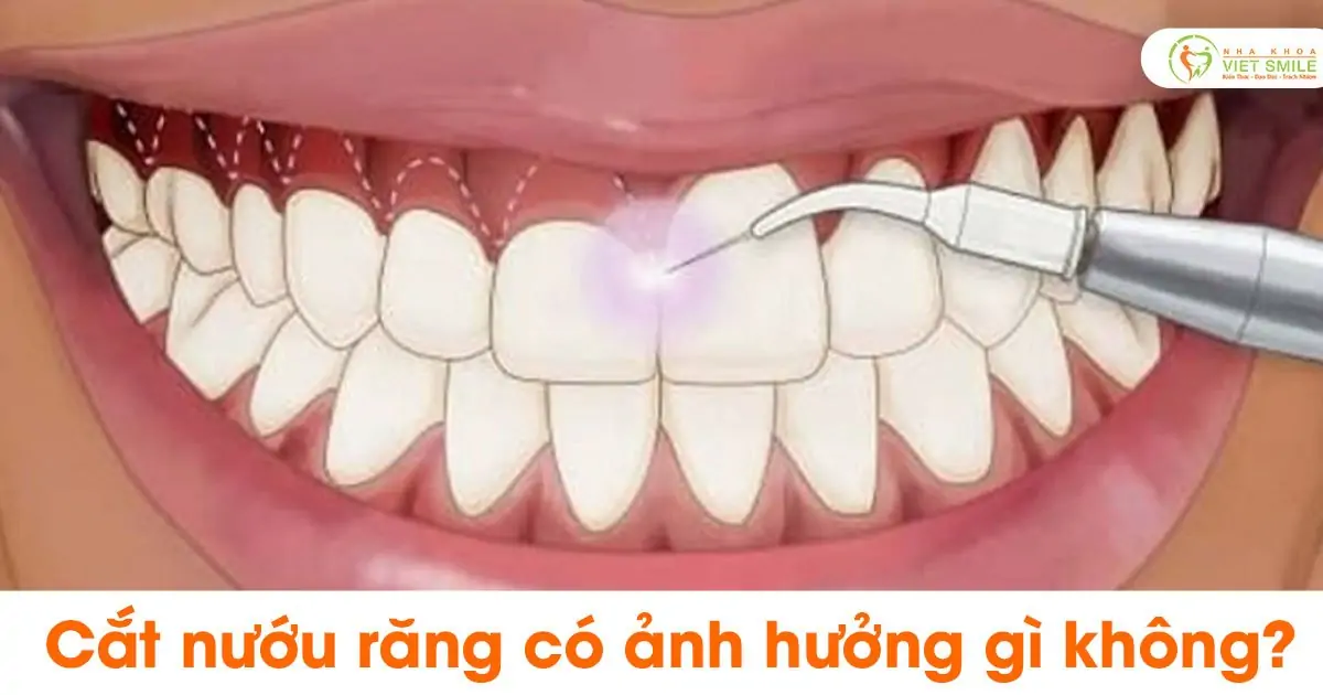 Cắt nướu răng có ảnh hưởng gì không?