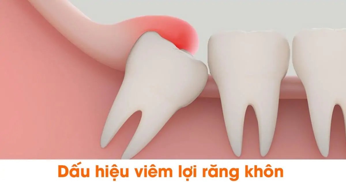 Dấu hiệu viêm lợi răng khôn