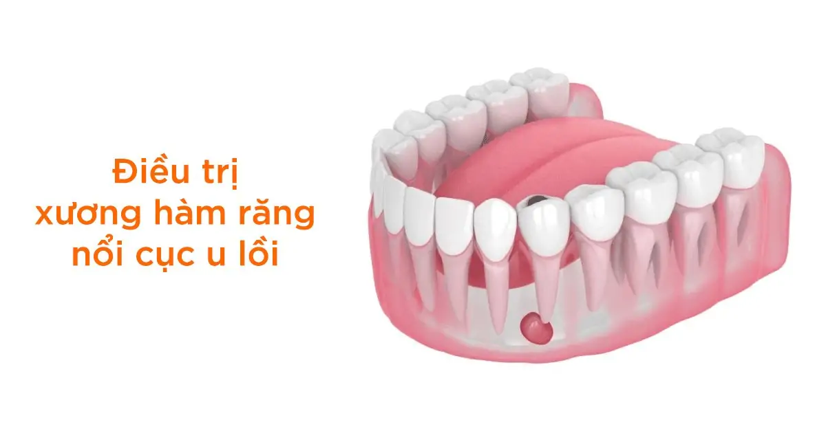 Điều trị xương hàm răng nổi cục u lồi