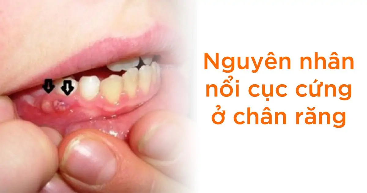 Nguyên nhân nổi cục cứng ở chân răng