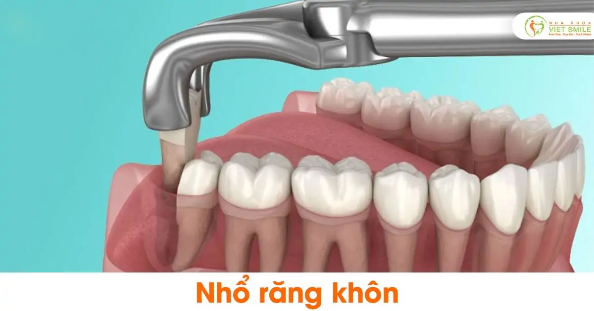 Nhổ răng khôn