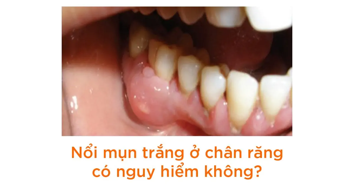 Nổi mụn trắng ở chân răng có nguy hiểm không?