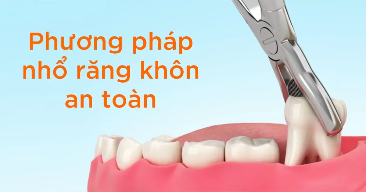 Phương pháp nhổ răng khôn an toàn