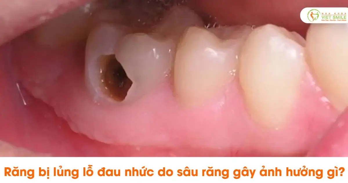 Răng bị lủng lỗ đau nhức do sâu răng gây ảnh hưởng gì?
