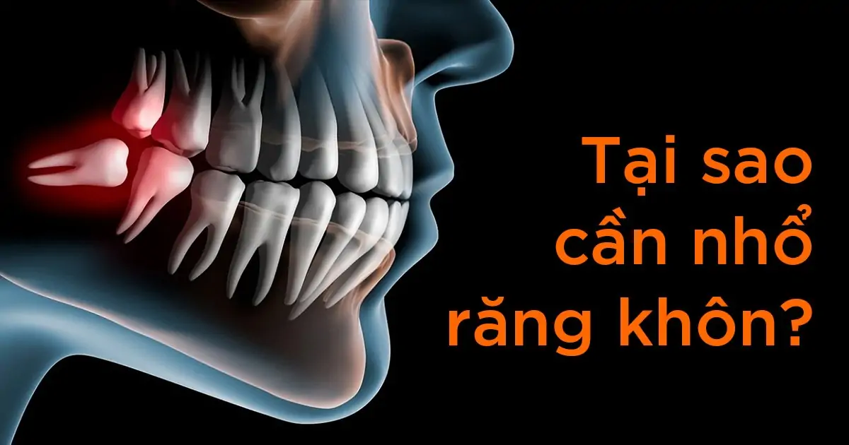 Tại sao cần nhổ răng khôn?