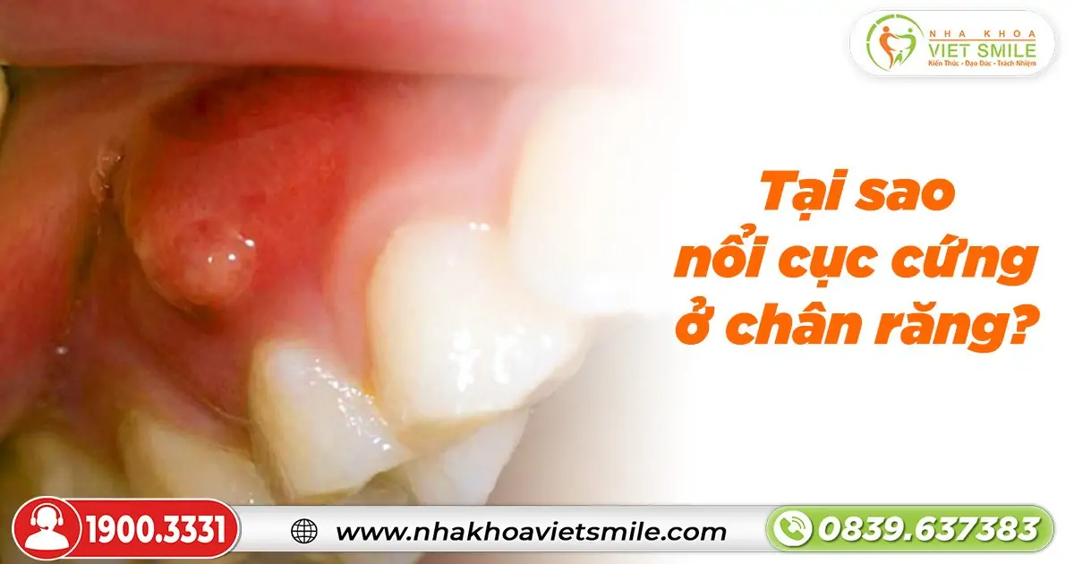 Tại sao nổi cục cứng ở chân răng?