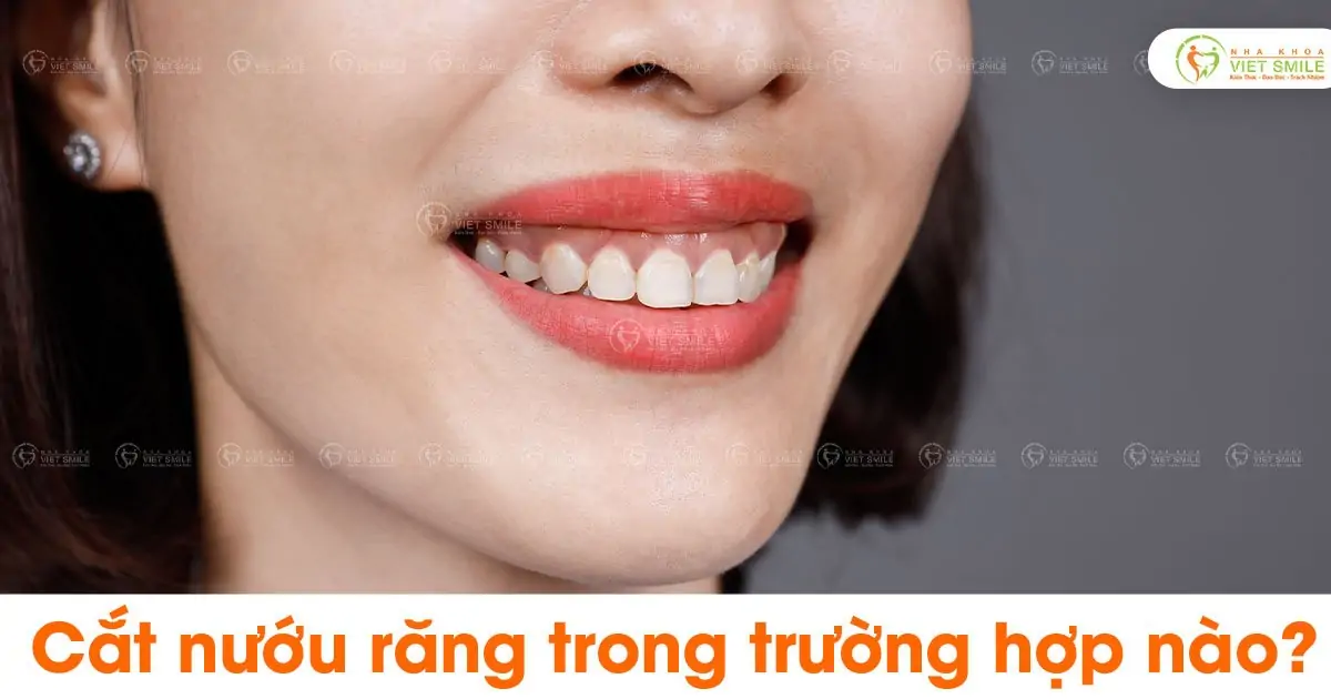 Cắt nướu răng trong trường hợp nào?