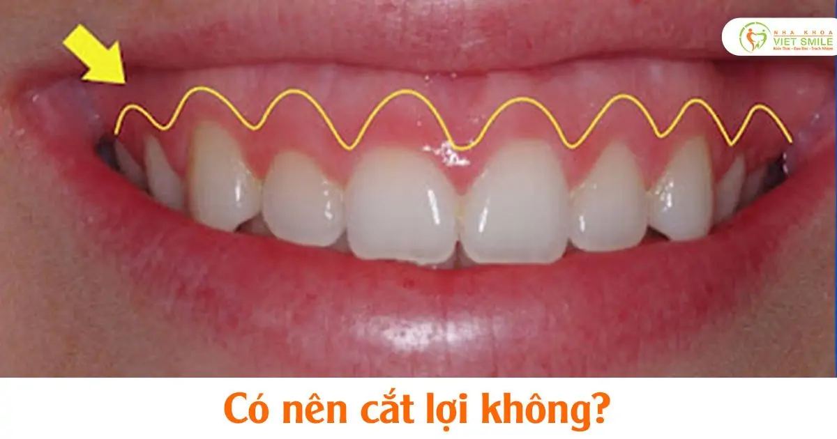Có nên cắt lợi không?