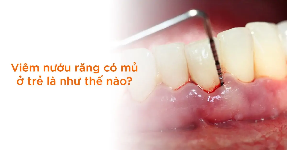 Viêm nướu răng có mủ ở trẻ là như thế nào?