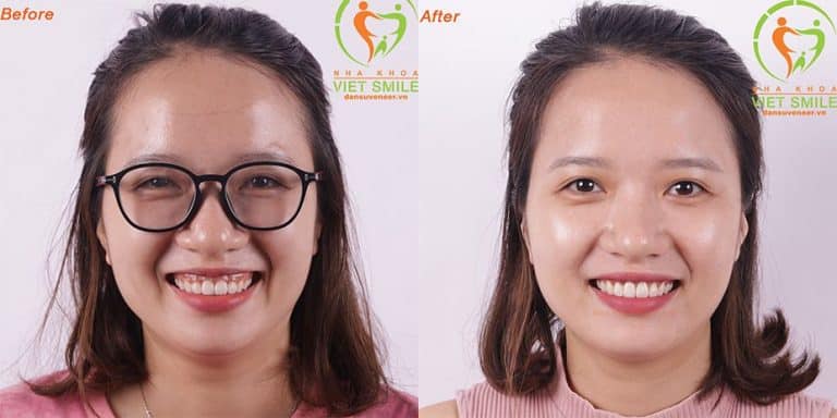VietSmile Trị Cười Hở Lợi