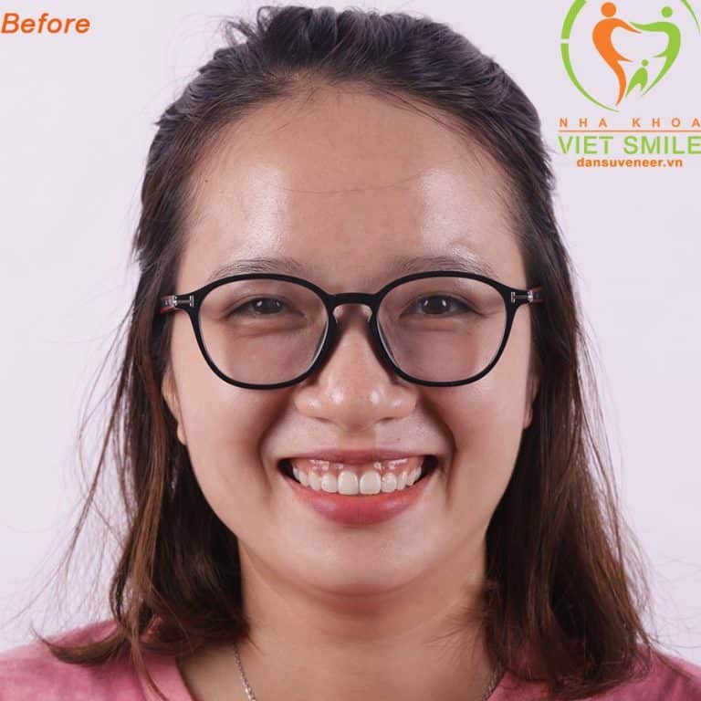 VietSmile Trị Cười Hở Lợi