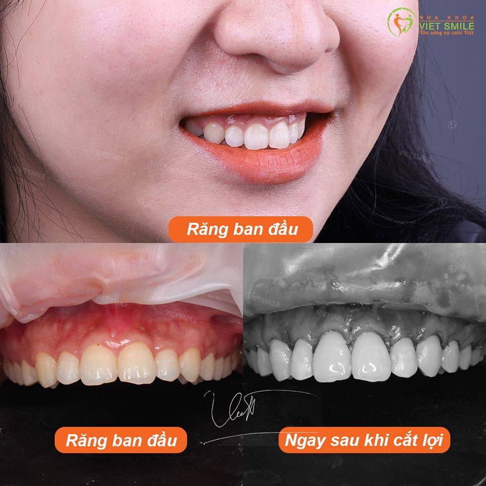 VietSmile Trị Cười Hở Lợi