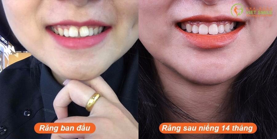 VietSmile Trị Cười Hở Lợi