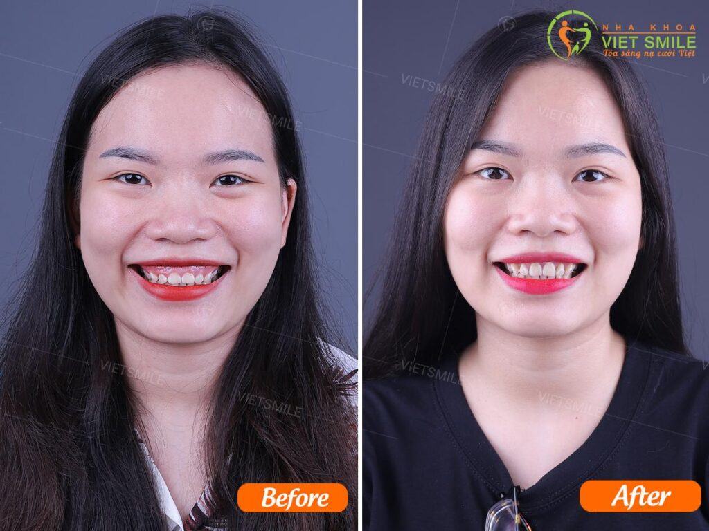 VietSmile Trị Cười Hở Lợi