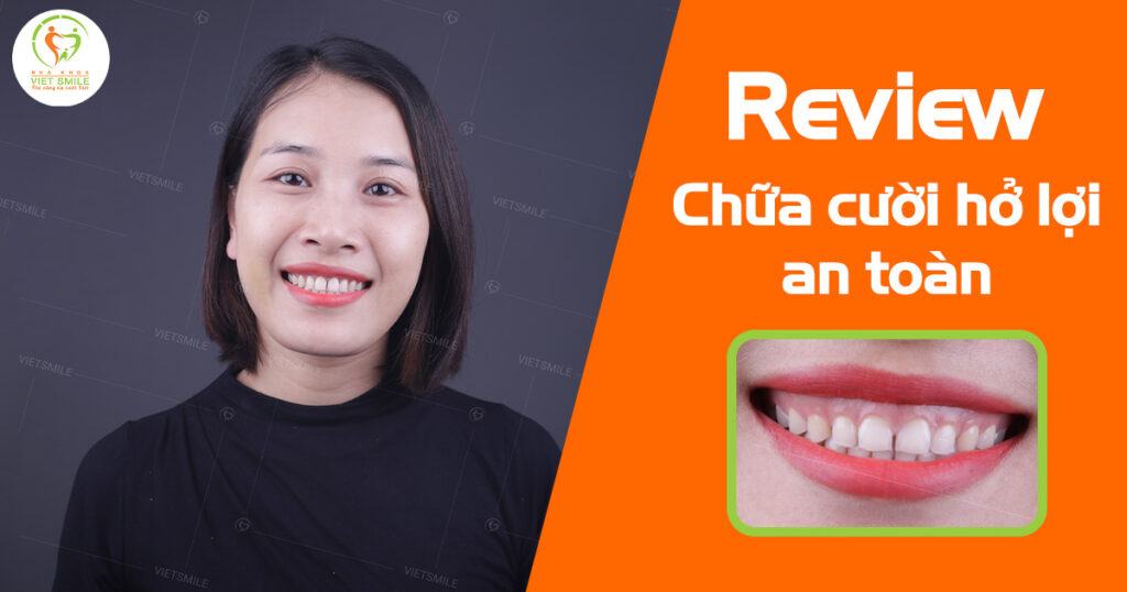VietSmile Trị Cười Hở Lợi