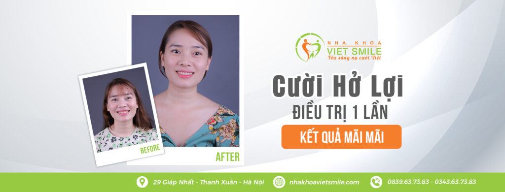 VietSmile Trị Cười Hở Lợi