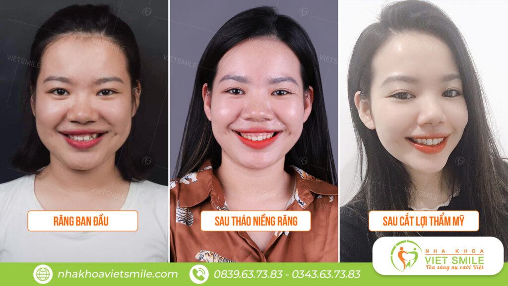 VietSmile Trị Cười Hở Lợi