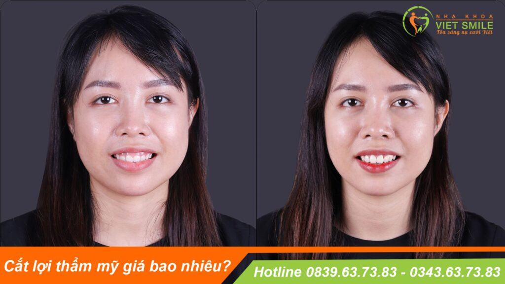 VietSmile Trị Cười Hở Lợi